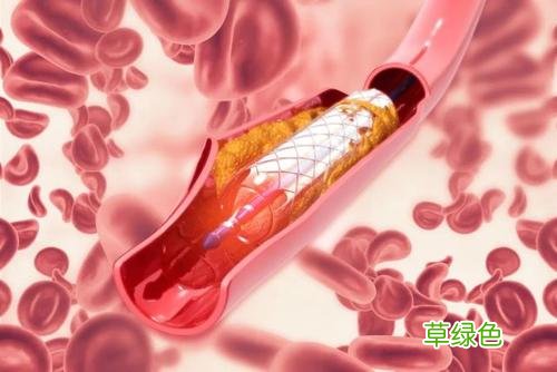 心血管堵塞百分之六十严重吗 心血管堵塞百分之18
