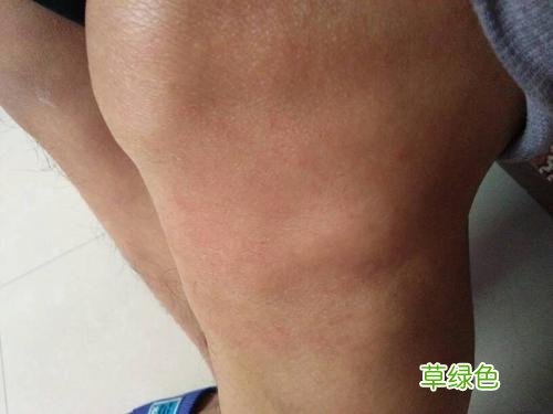 膝盖到小腿骨头发酸是怎么回事 膝盖下方骨头凸起发酸