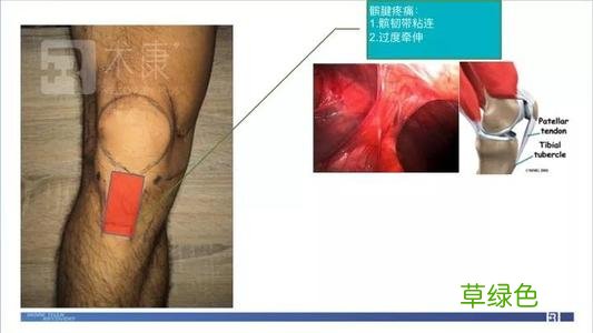 肌肉粘连不治会严重吗 膝盖肌肉粘连严重吗