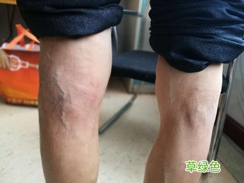 膝盖有积液老是响是怎么回事 膝盖抽积液后哗哗响