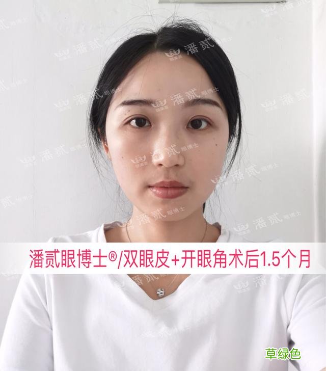 姑娘们20出头却眼睛显老，双眼皮手术上扬眼尾走起 怎么眼尾上扬