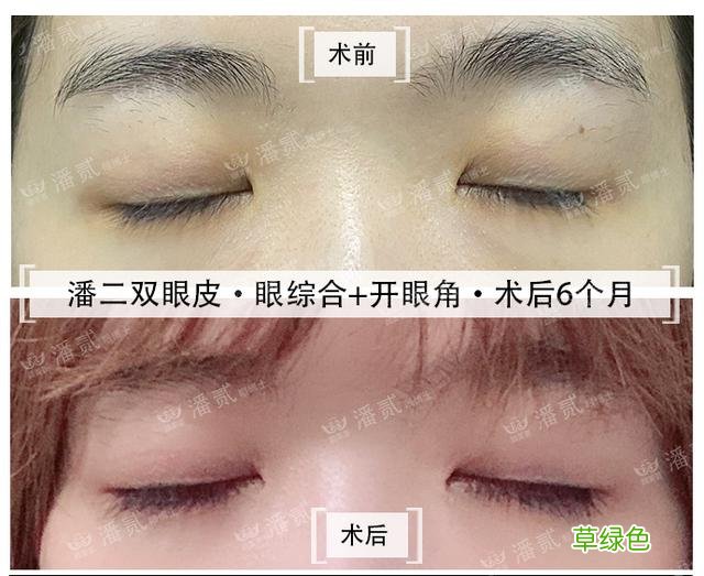 姑娘们20出头却眼睛显老，双眼皮手术上扬眼尾走起 怎么眼尾上扬