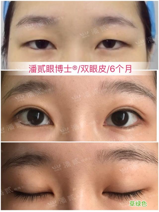 姑娘们20出头却眼睛显老，双眼皮手术上扬眼尾走起 怎么眼尾上扬