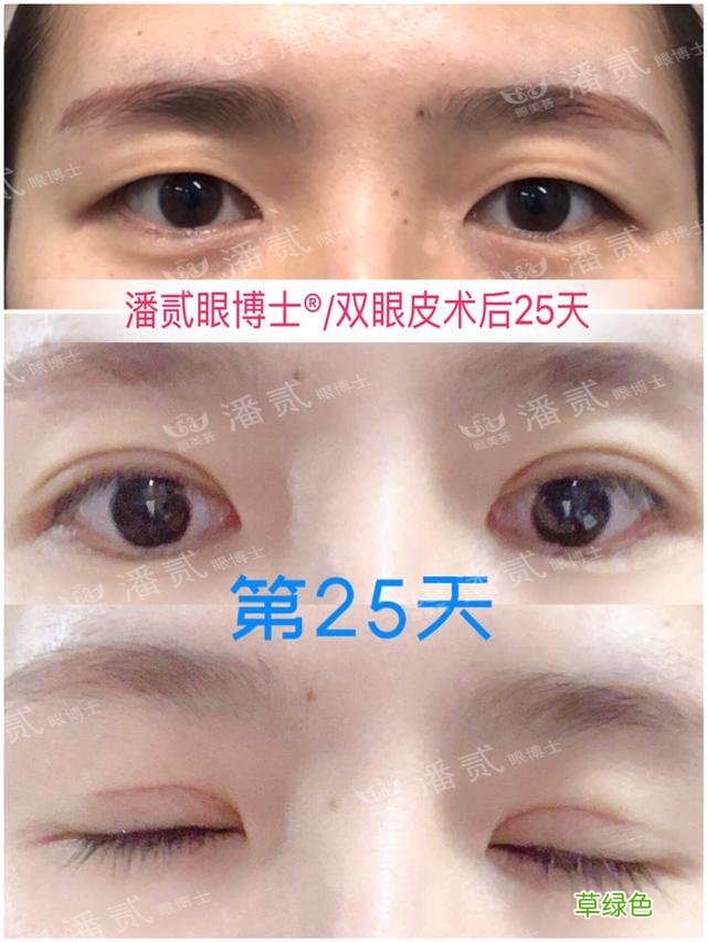 姑娘们20出头却眼睛显老，双眼皮手术上扬眼尾走起 怎么眼尾上扬