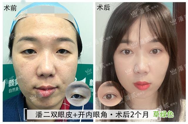 姑娘们20出头却眼睛显老，双眼皮手术上扬眼尾走起 怎么眼尾上扬