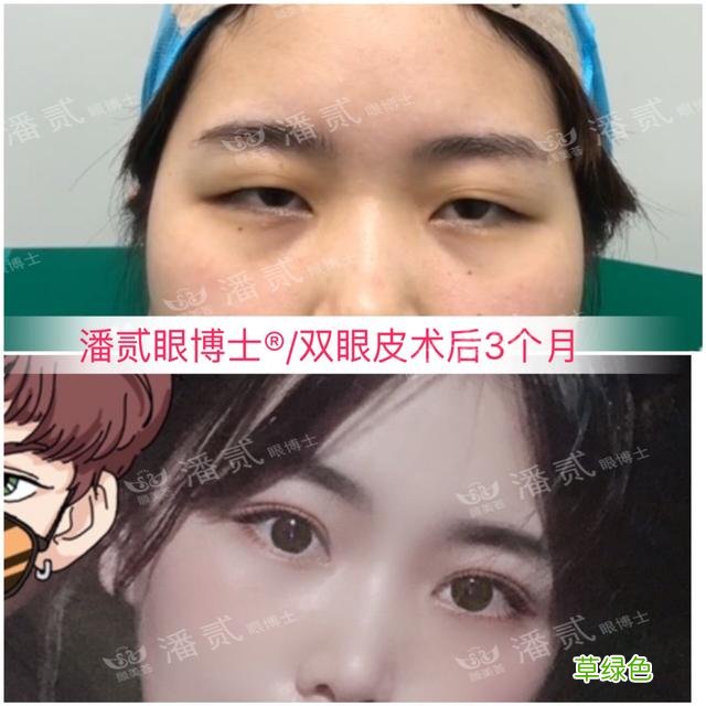 姑娘们20出头却眼睛显老，双眼皮手术上扬眼尾走起 怎么眼尾上扬