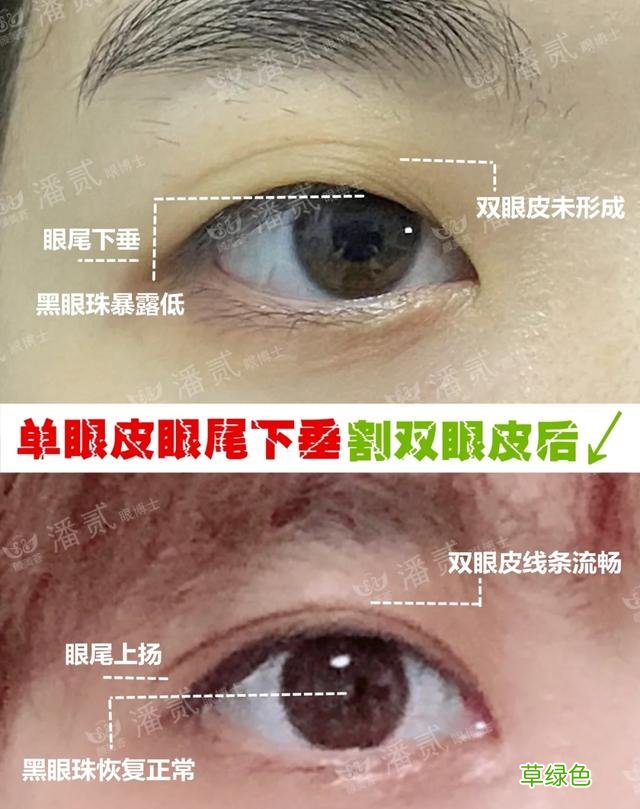 姑娘们20出头却眼睛显老，双眼皮手术上扬眼尾走起 怎么眼尾上扬