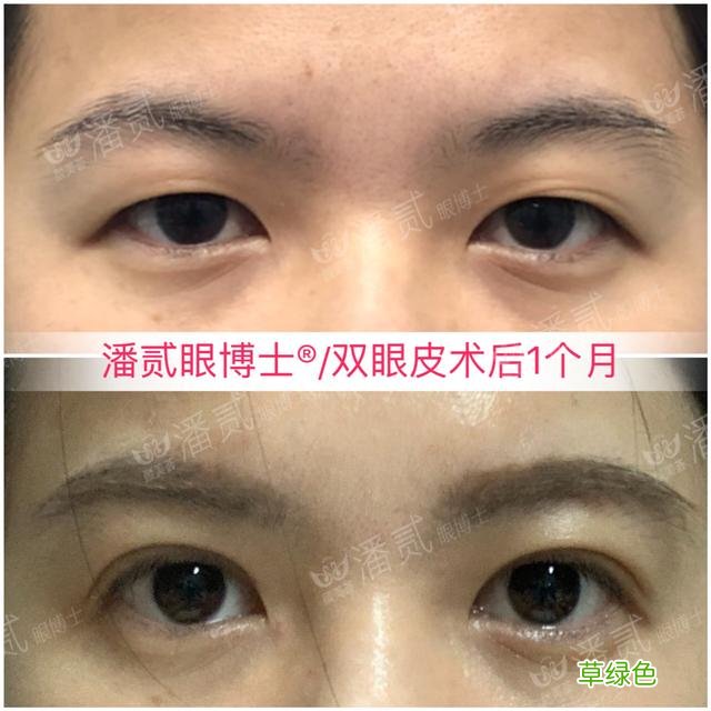 姑娘们20出头却眼睛显老，双眼皮手术上扬眼尾走起 怎么眼尾上扬