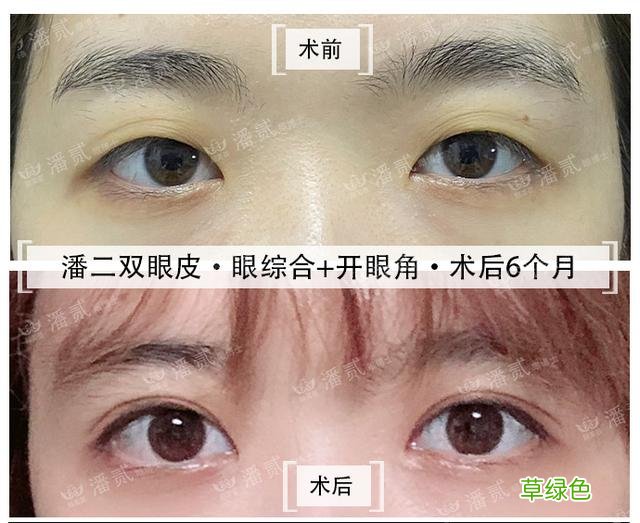 姑娘们20出头却眼睛显老，双眼皮手术上扬眼尾走起 怎么眼尾上扬