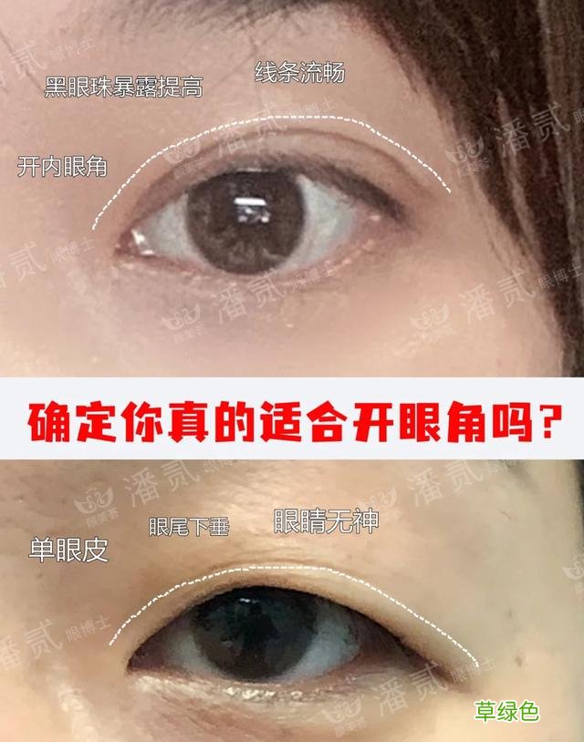 姑娘们20出头却眼睛显老，双眼皮手术上扬眼尾走起 怎么眼尾上扬