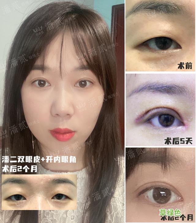 姑娘们20出头却眼睛显老，双眼皮手术上扬眼尾走起 怎么眼尾上扬