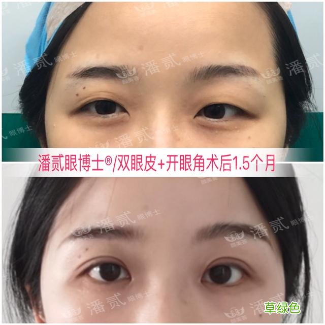姑娘们20出头却眼睛显老，双眼皮手术上扬眼尾走起 怎么眼尾上扬