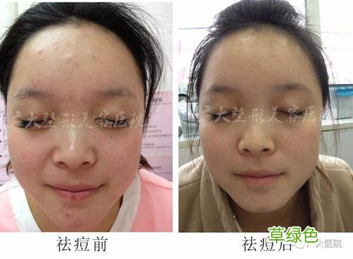 激光祛痘印后多久可以正常护肤 激光祛痘印后几天能洗脸