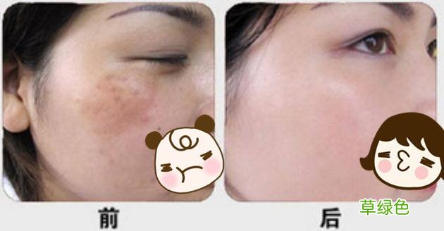 脸上长黄褐斑是怎么引起来的 黄褐斑的原因