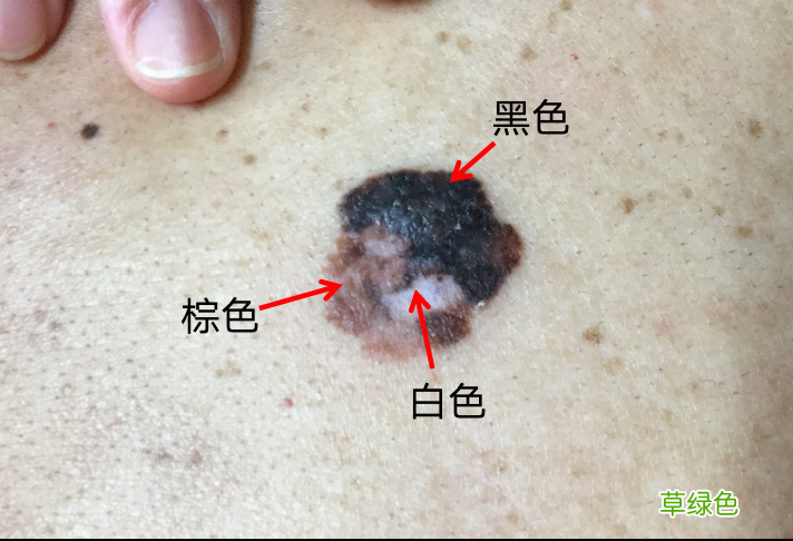 黑痣癌变的征兆图片 黑痣癌变图片