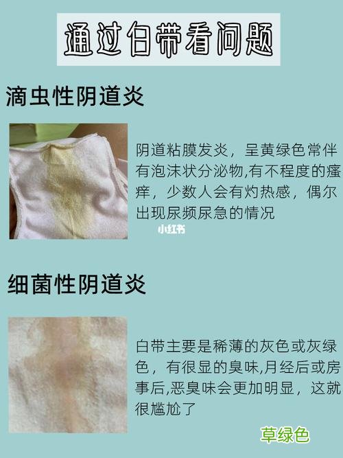 女性妇科白带增多是怎么回事 妇科白带异常