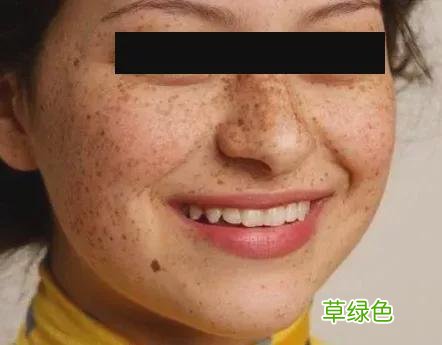 黄褐斑遗传多大开始长 黄褐斑遗传吗