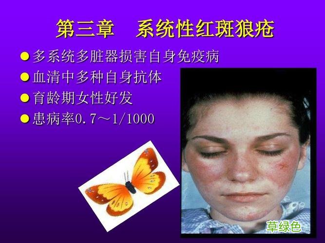 红斑狼疮图片早期症状 红斑狼疮图片