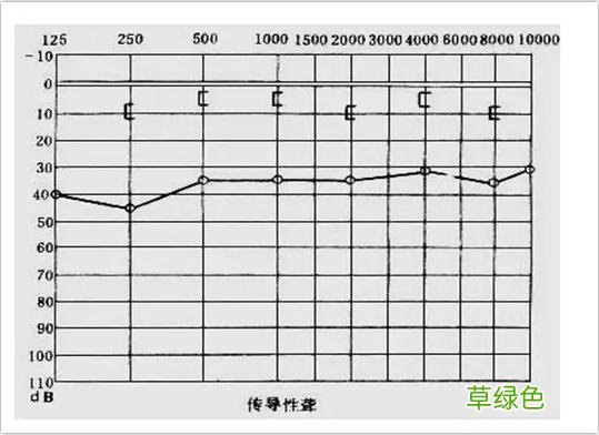 耳鸣耳聋的听力测试图怎么看？ 耳鸣怎么测试