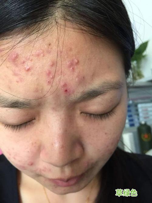 肝火旺脸上长斑图片 肝火旺脸上长斑