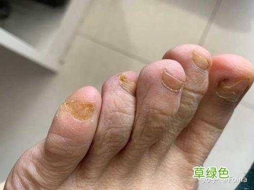醋精治疗灰指甲太痛了 醋精能治灰指甲吗