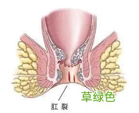 肛内有个小肉疙瘩怎么回事 肛门口长了个疙瘩
