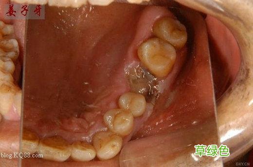 智齿拔牙后窟窿恢复图 拔牙后窟窿恢复图