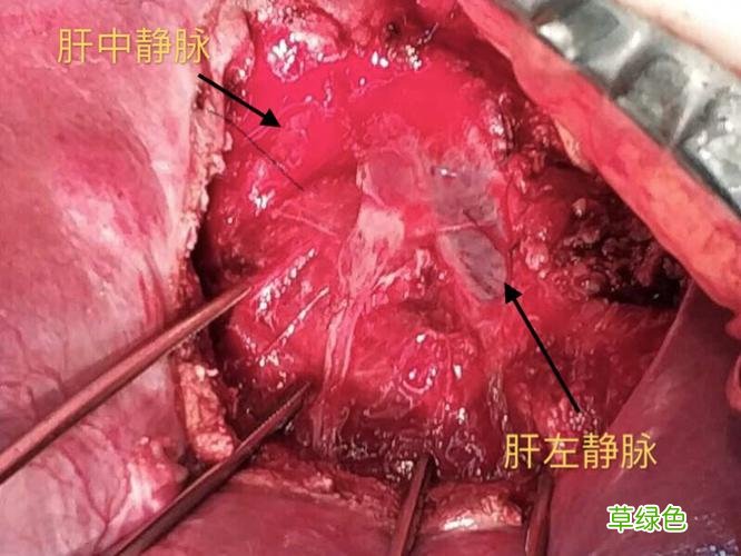肝脏血管瘤怎么治疗 肝脏血管瘤怎么治