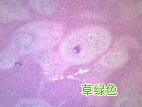 男性腹股沟淋巴结肿大 腹股沟肉芽肿