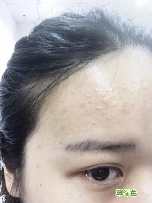 痘痘闭口粉刺怎么去除 闭口粉刺怎么去除