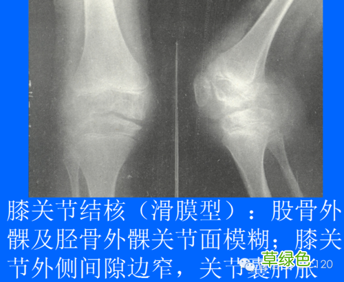 骨结核能不能治好 骨结核的治疗