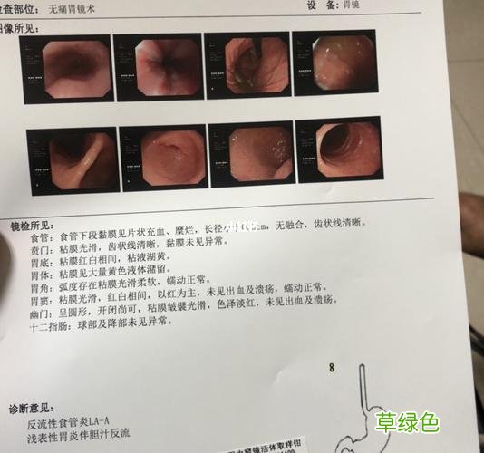胆汁反流性胃炎怎么根治 胆汁返流性胃炎