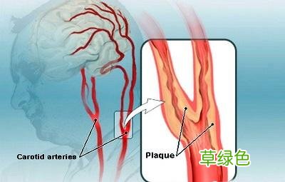 血管粥样动脉硬化症状 动脉硬化症状