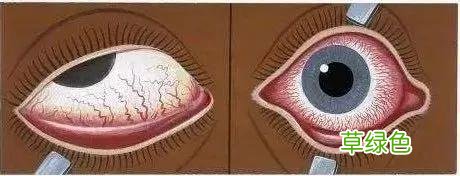 红眼病怎么治疗最快好 红眼病怎么治