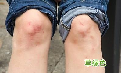 风湿性关节炎怎么治疗比较好 风湿病关节炎