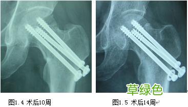 第五跖骨骨折愈合时间 骨折愈合时间