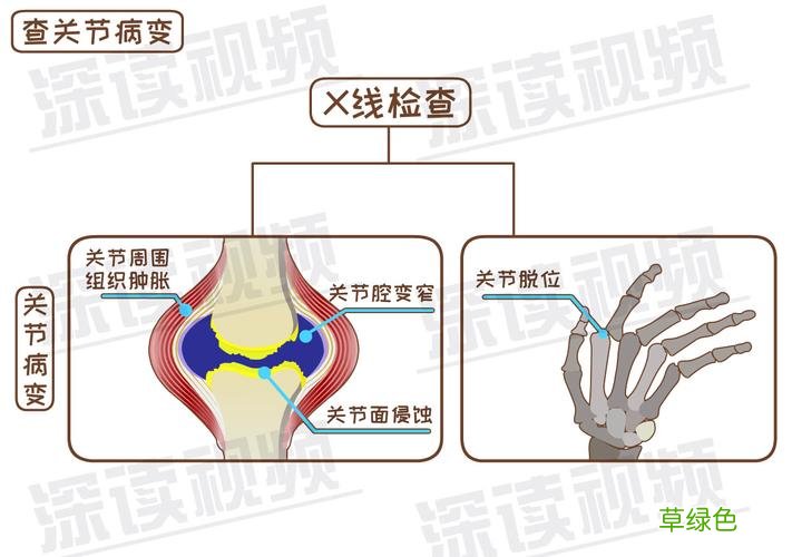 关节炎怎么治疗最好最有效的中药 关节炎怎么治