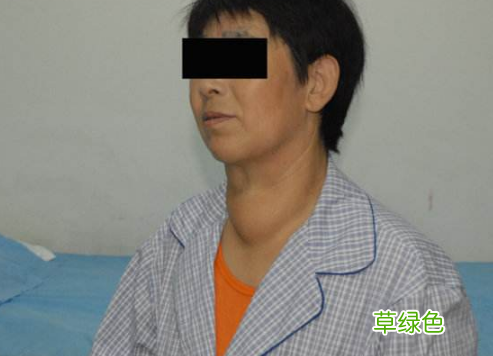 粗脖子病早期是什么症状 大脖子病的症状