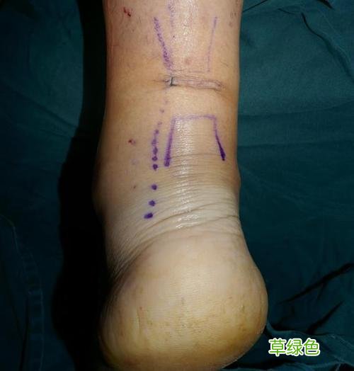 跟腱断裂的后果是什么 跟腱断裂的后果