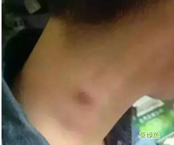 脖子上的淋巴长在哪里 脖子上的淋巴