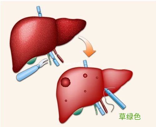 肝癌晚期食谱治疗方法 肝癌晚期治疗方法