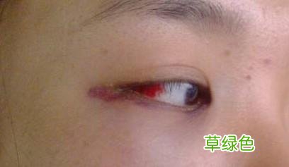 眼睛充血怎么办 白眼球充血怎么办