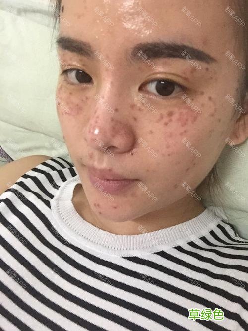 激光去斑仪器有效吗 激光去斑有效吗