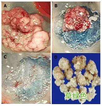 肠多发息肉严重吗 大肠多发息肉