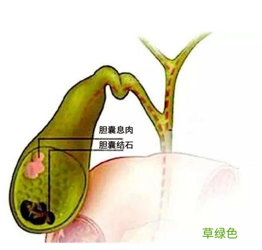 乌梅治胆囊息肉偏方 胆囊息肉偏方