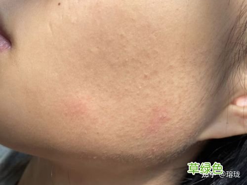 鸡皮肤需要去医院治疗吗 鸡皮肤怎么治