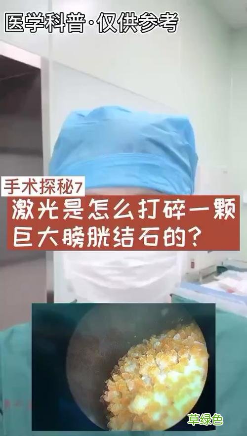 膀胱结石怎样治疗效果最好 膀胱结石治疗