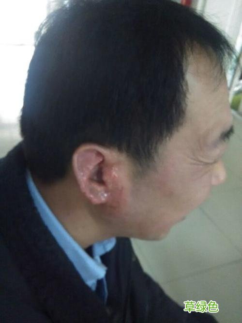儿童中耳炎的症状表现形式 宝宝中耳炎症状
