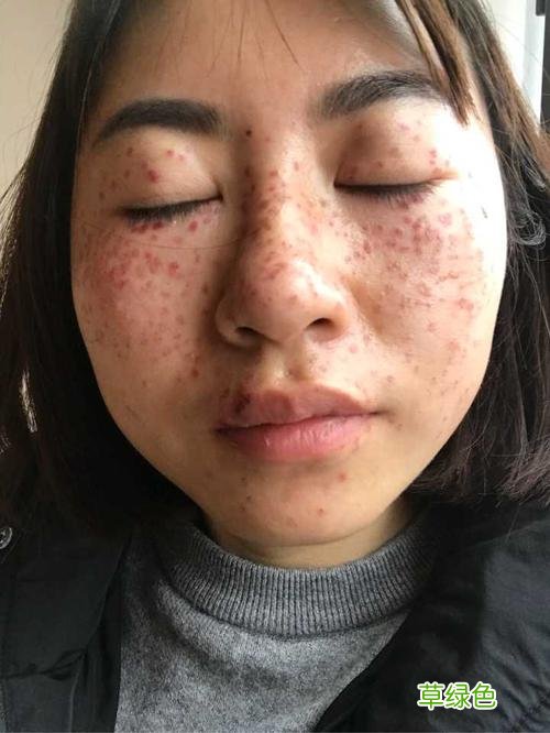 激光祛斑的副作用