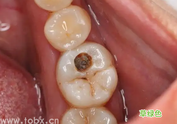 注意了！你牙齿上的小黑洞，是个烧钱的无底洞